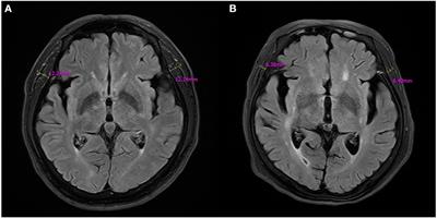 Correlation between temporal muscle thickness and grip strength in hemiplegic patients with acute stroke